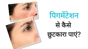 Skin Pigmentation in hindi