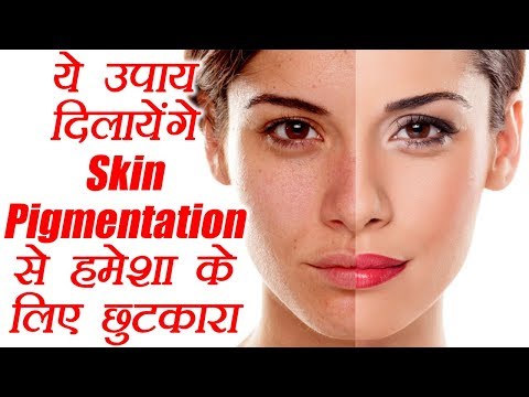 Skin Pigmentation